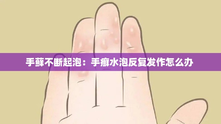 手藓不断起泡:手癣水泡反复发作怎么办